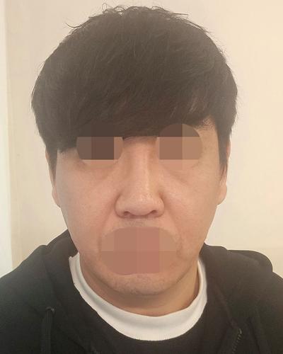 스마스거상에 티타늄 리프팅까지, 관리 만족도 진짜 커요 사진 3 — 아바성형외과 안면거상 후기
