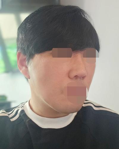 스마스거상에 티타늄 리프팅까지, 관리 만족도 진짜 커요 사진 5 — 아바성형외과 안면거상 후기