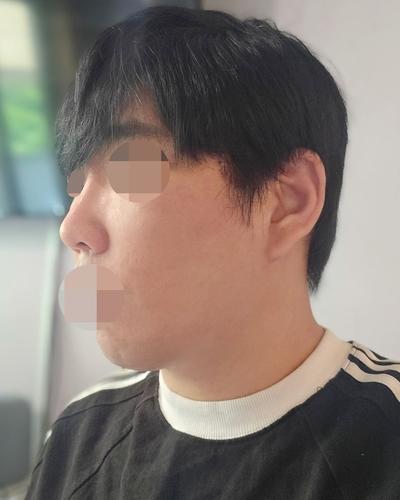 스마스거상에 티타늄 리프팅까지, 관리 만족도 진짜 커요 사진 6 — 아바성형외과 안면거상 후기