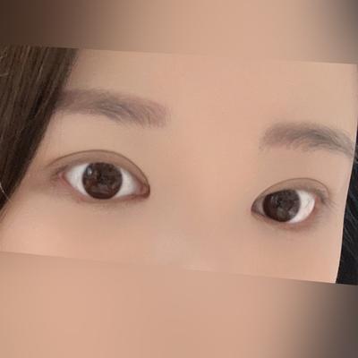 눈성형 환자 후기 — 3년전 자연유착 쌍커풀 수술... (424)