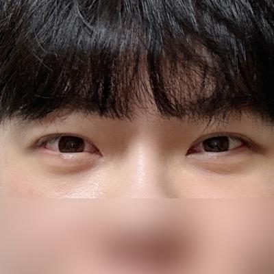 시술 6주차, 졸려 보인다는 소리 이제 안 들어요 — 아바성형외과 환자 후기 사진