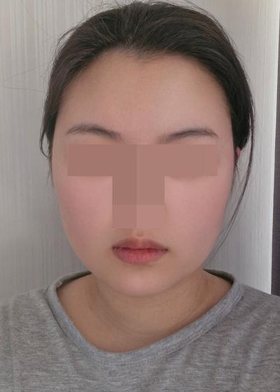 이중턱지방흡입 4주차, 멍도 없고 턱라인 갸름해졌어요 — 아바성형외과 환자 후기 사진