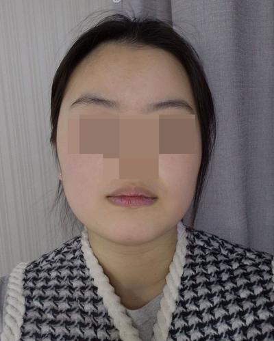 이중턱지방흡입 4주차, 멍도 없고 턱라인 갸름해졌어요 사진 2 — 아바성형외과 이중턱·윤곽 후기