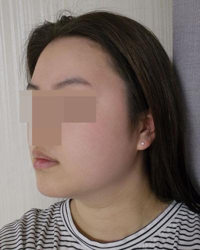이중턱지방흡입 4주차, 멍도 없고 턱라인 갸름해졌어요 사진 3 — 아바성형외과 이중턱·윤곽 후기