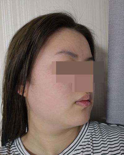 이중턱지방흡입 4주차, 멍도 없고 턱라인 갸름해졌어요 사진 4 — 아바성형외과 이중턱·윤곽 후기