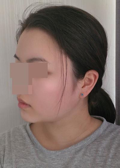 이중턱지방흡입 4주차, 멍도 없고 턱라인 갸름해졌어요 사진 5 — 아바성형외과 이중턱·윤곽 후기