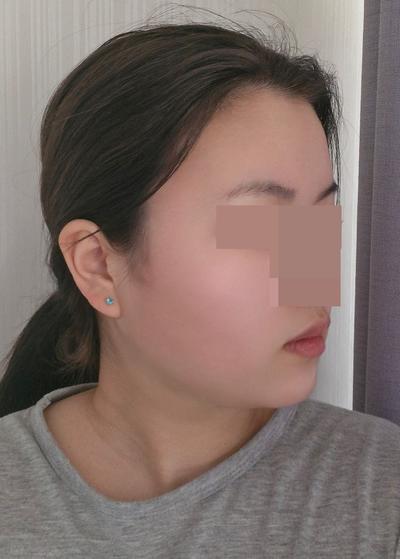 이중턱지방흡입 4주차, 멍도 없고 턱라인 갸름해졌어요 사진 6 — 아바성형외과 이중턱·윤곽 후기