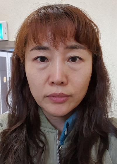 수술 6주차, 광대 잔통증 가끔 있지만 비교적 괜찮아요 사진 2 — 아바성형외과 기타 후기