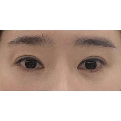 눈밑지방재배치 8주차, 꼼꼼히 해주셔서 대만족입니다 — 아바성형외과 환자 후기 사진
