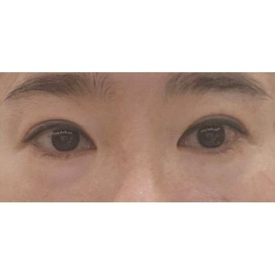 눈밑지방재배치 8주차, 꼼꼼히 해주셔서 대만족입니다 사진 2 — 아바성형외과 눈밑지방재배치 후기