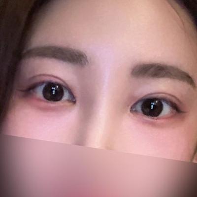 2주차인데 벌써 이 정도, 붓기 멍 진짜 빨리 빠졌어요 — 아바성형외과 환자 후기 사진