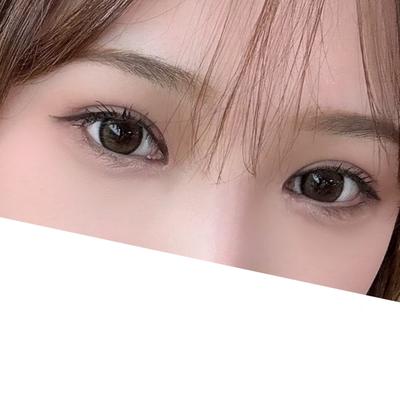 쌍꺼풀 재수술 2개월차, 꼬막눈이 확 트였어요 — 아바성형외과 환자 후기 사진