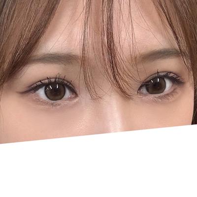 쌍꺼풀 재수술 2개월차, 꼬막눈이 확 트였어요 사진 4 — 아바성형외과 쌍꺼풀·눈성형 후기