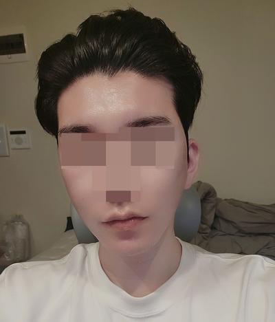 광대·사각턱·안면거상 3개월차, 인상 좋아졌다는 말 많이 들어요 — 아바성형외과 환자 후기 사진
