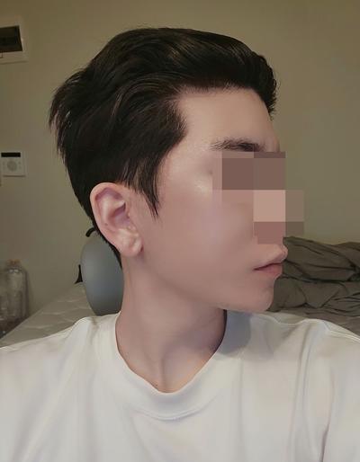 광대·사각턱·안면거상 3개월차, 인상 좋아졌다는 말 많이 들어요 사진 4 — 아바성형외과 안면거상 후기