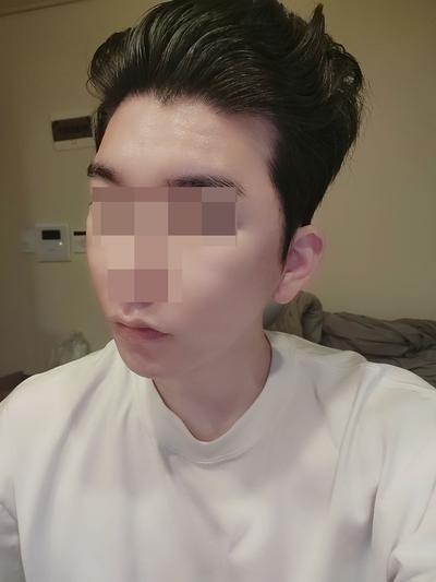 광대·사각턱·안면거상 3개월차, 인상 좋아졌다는 말 많이 들어요 사진 5 — 아바성형외과 안면거상 후기