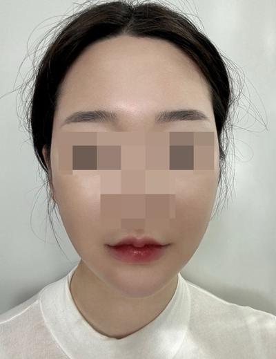 안면거상 7주차, 붓기 빠지니 얼굴살 확 올라갔어요 — 아바성형외과 환자 후기 사진