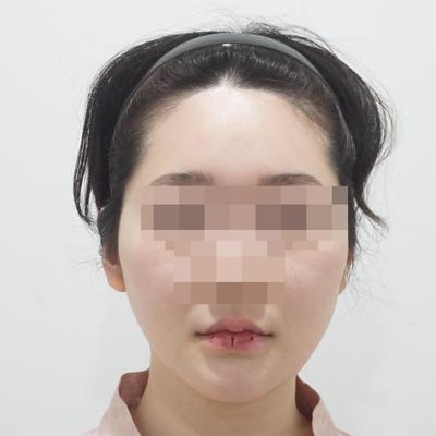 안면거상 7주차, 붓기 빠지니 얼굴살 확 올라갔어요 사진 2 — 아바성형외과 안면거상 후기