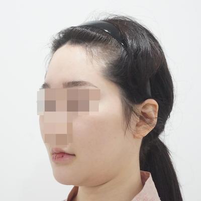 안면거상 7주차, 붓기 빠지니 얼굴살 확 올라갔어요 사진 3 — 아바성형외과 안면거상 후기