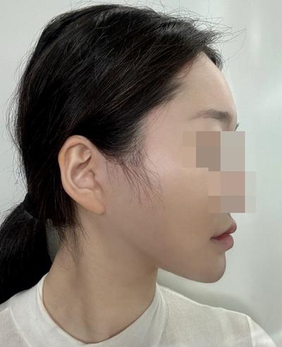 안면거상 7주차, 붓기 빠지니 얼굴살 확 올라갔어요 사진 5 — 아바성형외과 안면거상 후기