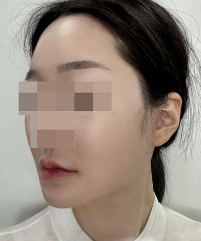 안면거상 7주차, 붓기 빠지니 얼굴살 확 올라갔어요 사진 6 — 아바성형외과 안면거상 후기