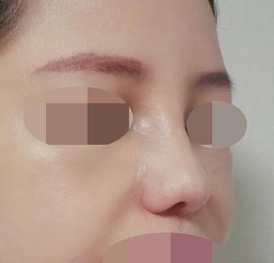 수술 3개월차, 친한 친구도 눈치 못 챌 만큼 자연스러워요 — 아바성형외과 환자 후기 사진