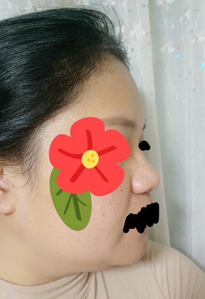 수술 3개월차, 친한 친구도 눈치 못 챌 만큼 자연스러워요 사진 2 — 아바성형외과 쌍꺼풀·눈성형 후기
