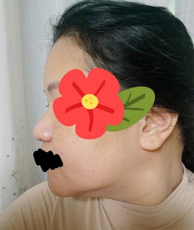 수술 3개월차, 친한 친구도 눈치 못 챌 만큼 자연스러워요 사진 3 — 아바성형외과 쌍꺼풀·눈성형 후기