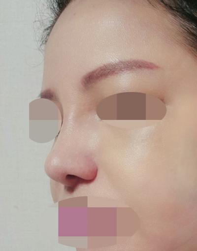 수술 3개월차, 친한 친구도 눈치 못 챌 만큼 자연스러워요 사진 4 — 아바성형외과 쌍꺼풀·눈성형 후기