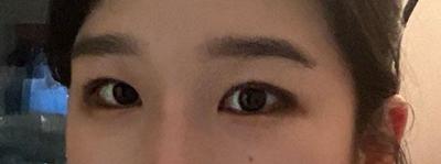 매몰 쌍꺼풀＋눈매교정, 원한 속쌍 라인 그대로 나왔어요 — 아바성형외과 환자 후기 사진