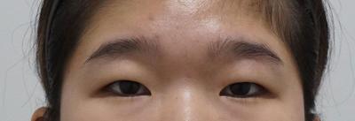 매몰 쌍꺼풀＋눈매교정, 원한 속쌍 라인 그대로 나왔어요 사진 2 — 아바성형외과 쌍꺼풀·눈성형 후기