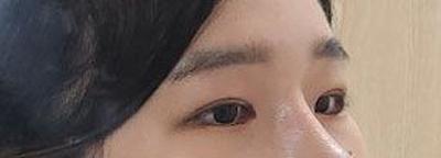 매몰 쌍꺼풀＋눈매교정, 원한 속쌍 라인 그대로 나왔어요 사진 3 — 아바성형외과 쌍꺼풀·눈성형 후기