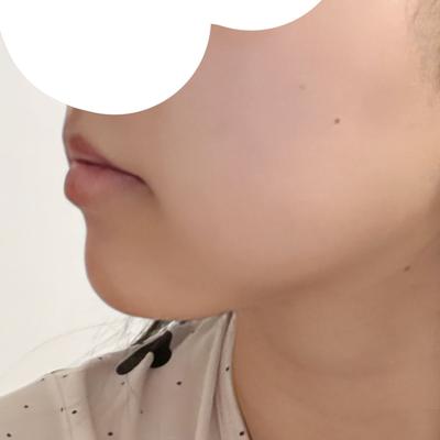 이중턱근육묶기 상담 후기, 얼지흡 안 해도 된다고 하셨어요 — 아바성형외과 환자 후기 사진