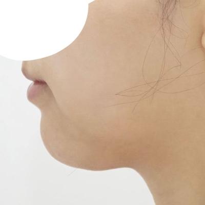 이중턱근육묶기 상담 후기, 얼지흡 안 해도 된다고 하셨어요 사진 2 — 아바성형외과 이중턱·윤곽 후기
