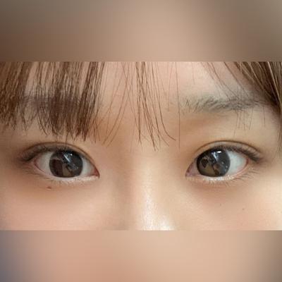 눈밑지방재배치 뒤밑트임 재수술 6주차, 퀭한 느낌 없어졌어요 — 아바성형외과 환자 후기 사진