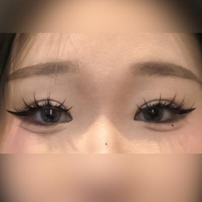 쌍꺼풀 절개 2주차, 인상 부드러워졌다는 말 많이 들어요 — 아바성형외과 환자 후기 사진