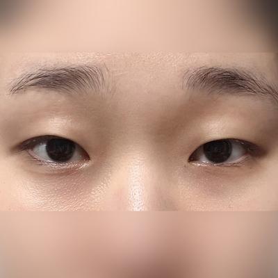 쌍꺼풀 절개 2주차, 인상 부드러워졌다는 말 많이 들어요 사진 2 — 아바성형외과 쌍꺼풀·눈성형 후기