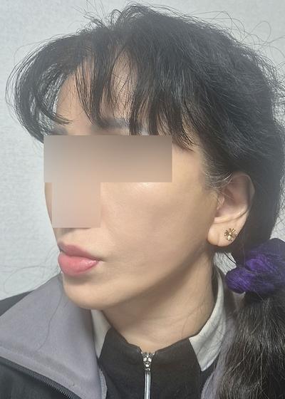 6주차, 목주름 얼굴주름 확 개선되고 젊어졌어요 — 아바성형외과 환자 후기 사진