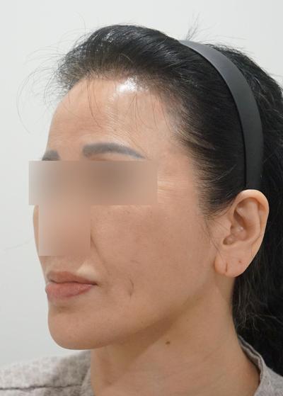 6주차, 목주름 얼굴주름 확 개선되고 젊어졌어요 사진 2 — 아바성형외과 기타 후기
