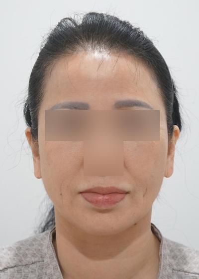 6주차, 목주름 얼굴주름 확 개선되고 젊어졌어요 사진 3 — 아바성형외과 기타 후기