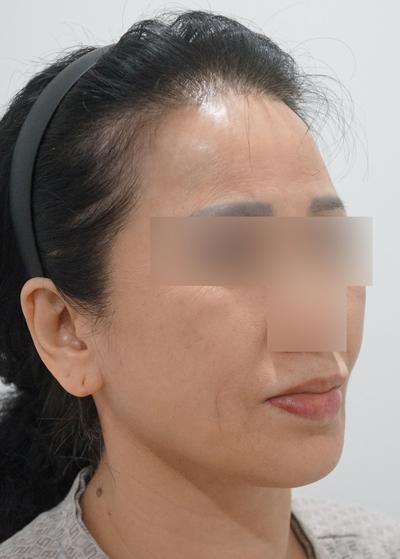 6주차, 목주름 얼굴주름 확 개선되고 젊어졌어요 사진 4 — 아바성형외과 기타 후기