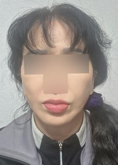 6주차, 목주름 얼굴주름 확 개선되고 젊어졌어요 사진 5 — 아바성형외과 기타 후기