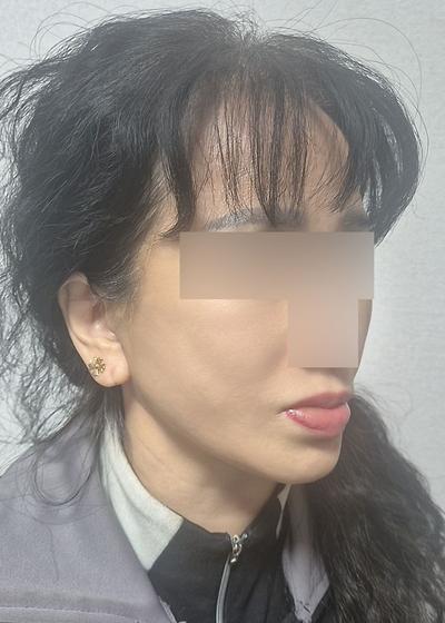 6주차, 목주름 얼굴주름 확 개선되고 젊어졌어요 사진 6 — 아바성형외과 기타 후기