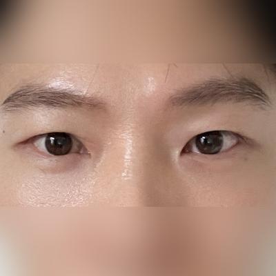 눈밑지방 수술 4주차, 나이들어 보이던 고민 완전 해결됐어요 — 아바성형외과 환자 후기 사진