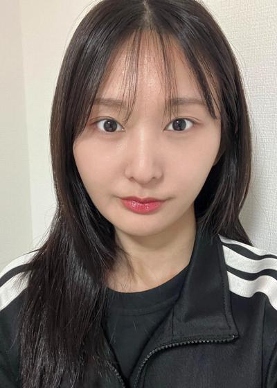 눈밑지방재배치 후 화장 안 해도 다크서클 안 보여요 사진 4 — 아바성형외과 눈밑지방재배치 후기