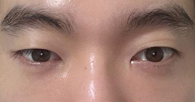 눈밑지방재배치 8주차, 퀭해 보였던 눈이 확 밝아졌어요 — 아바성형외과 환자 후기 사진