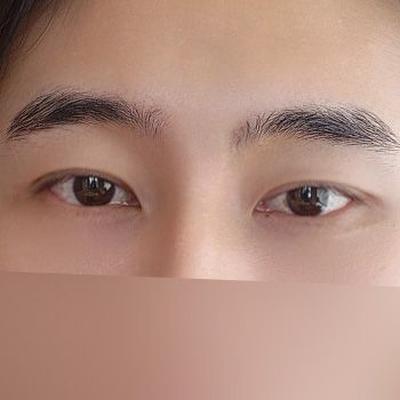 수술 한 달차, 회복 빠르고 지금 굉장히 만족스러워요 — 아바성형외과 환자 후기 사진
