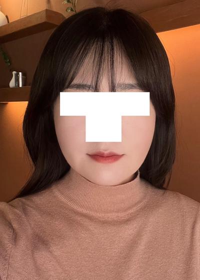 윤곽 5주차, 턱처짐 없고 옆에서 본 턱라인이 엄청 갸름해졌어요 — 아바성형외과 환자 후기 사진