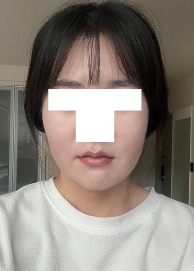 윤곽 5주차, 턱처짐 없고 옆에서 본 턱라인이 엄청 갸름해졌어요 사진 2 — 아바성형외과 이중턱·윤곽 후기