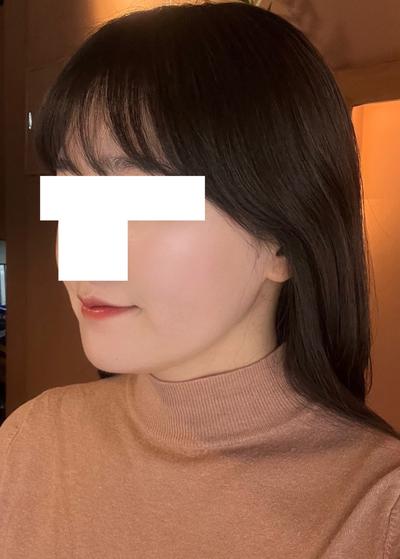 윤곽 5주차, 턱처짐 없고 옆에서 본 턱라인이 엄청 갸름해졌어요 사진 5 — 아바성형외과 이중턱·윤곽 후기